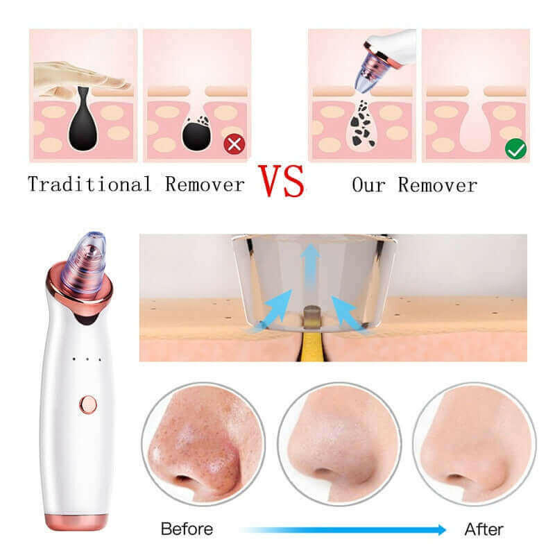 Facial Blackhead Remover Electric Vacuum Machine.